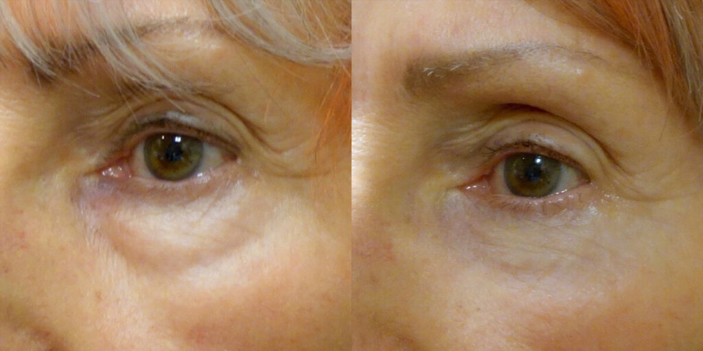 Lower Eyelid Patient-1