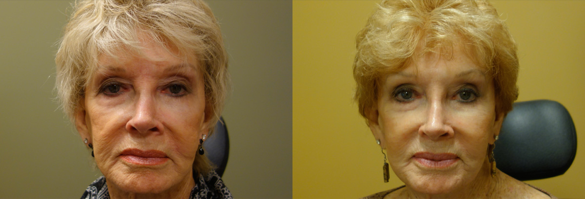 Injectable Filler Patient 2 Before After Other Other Front Angle Dr. Joseph Inland Empire