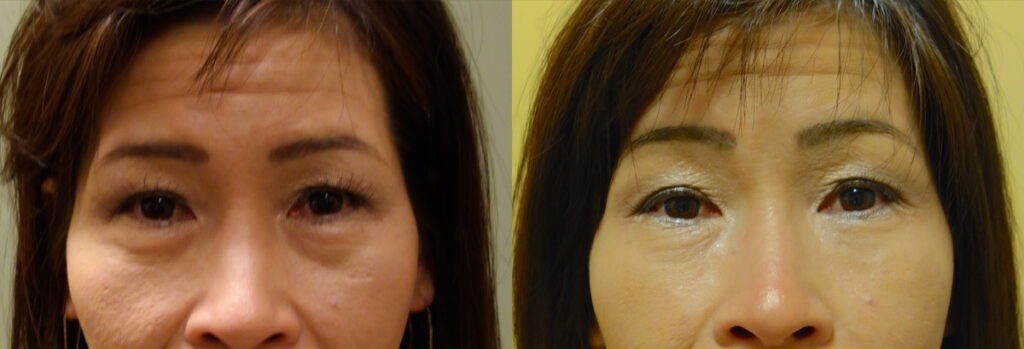 Injectable Filler Patient-3