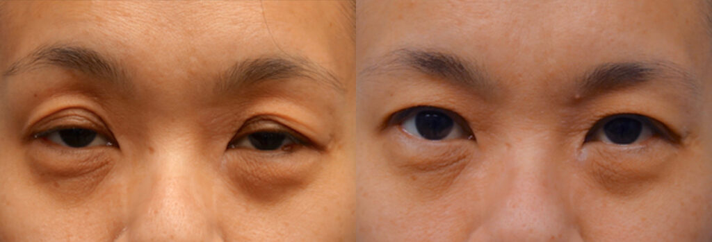 Asian Eyelid Patient-3