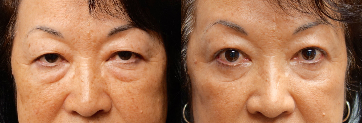 Upper Blepharoplasty Before and After Photo Gallery Patient 1 Front Angle Infocus Inland Empire