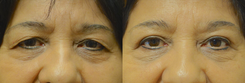 Upper Eyelid Patient-2