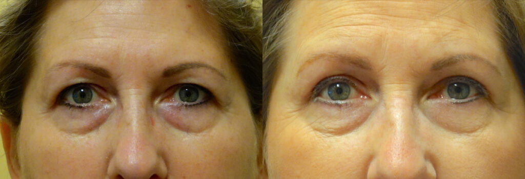 Upper Eyelid Patient-3