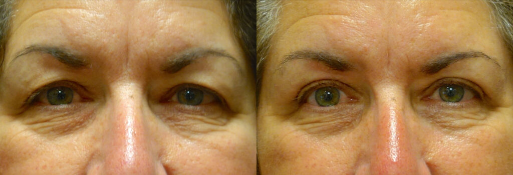 Upper Eyelid Patient-4