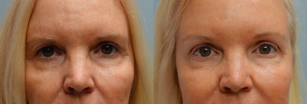 Browlift Patient-4