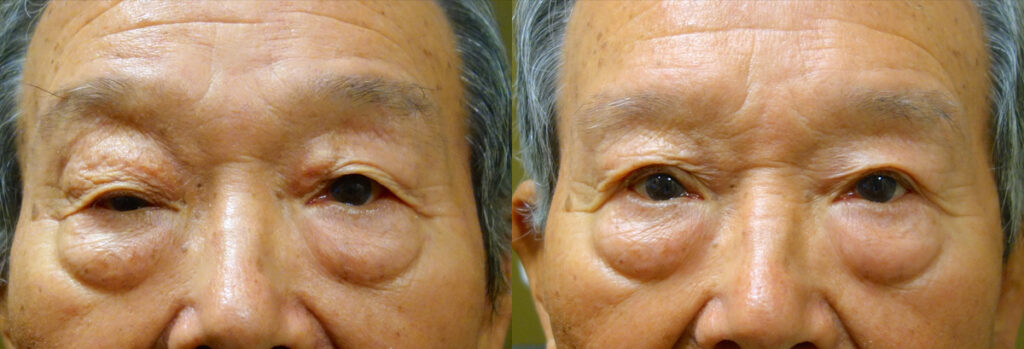 Eyelid surgery revision Patient