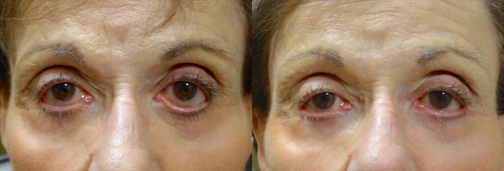 Eyelid Patient-1