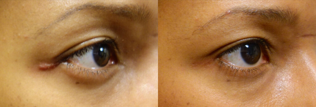 Eyelid Patient-3