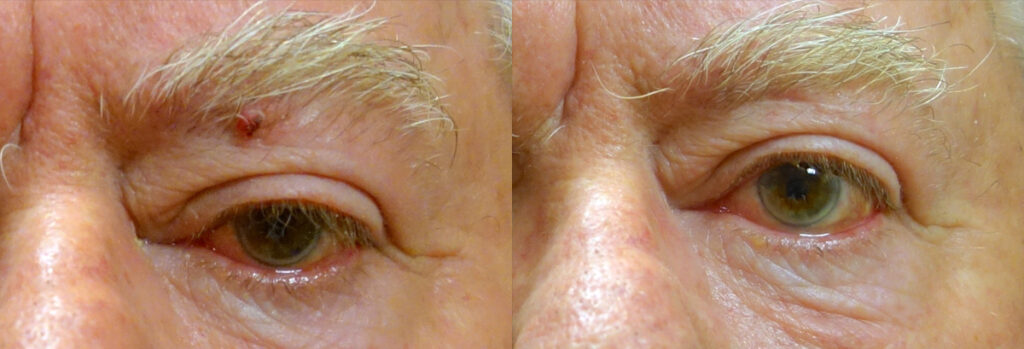 Eyelid Skin Cancer Patient-1