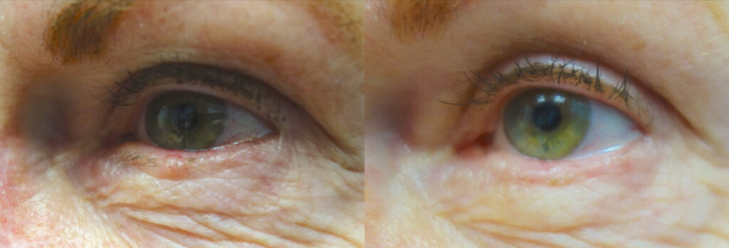 Eyelid Skin Cancer Patient-2