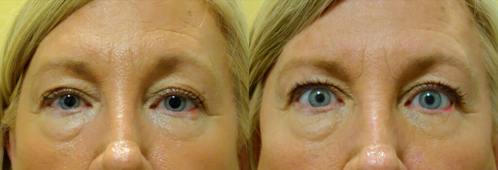 Eyelid Skin Cancer Patient-3