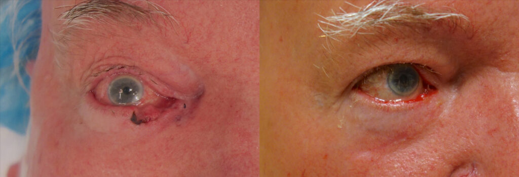 Eyelid Skin Cancer Patient-4