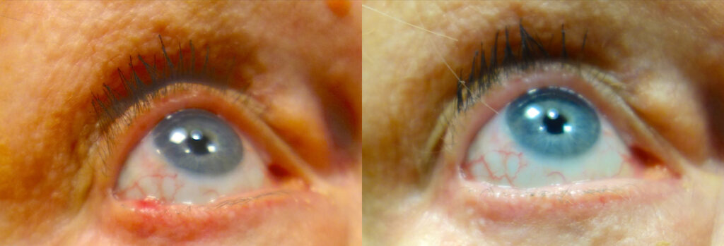 Eyelid Skin Cancer Patient-5