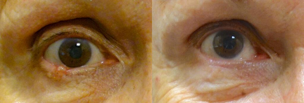 Eyelid Skin Cancer Patient-6