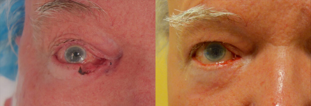 Eyelid Skin Cancer Patient-7