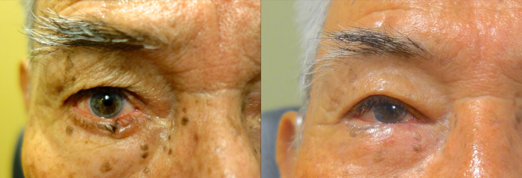 Eyelid Skin Cancer Patient-8