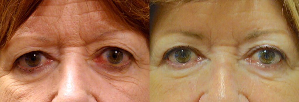 Eyelid Retraction Patient-2