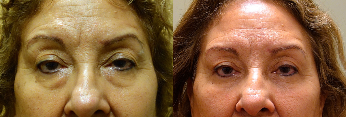 Lower Blepharoplasty Before and After Patient 5 Dr. Joseph Infocus Inland Empire