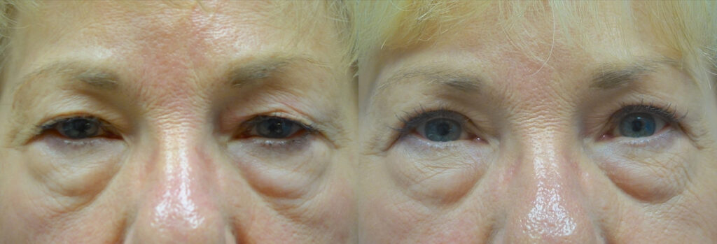 Upper Eyelid Patient-9