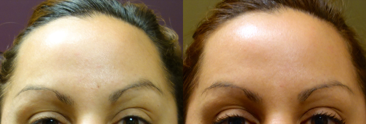 Botox Before and After Photo Gallery Patient 1 Front Angle Dr. Joseph Infocus Inland Empire