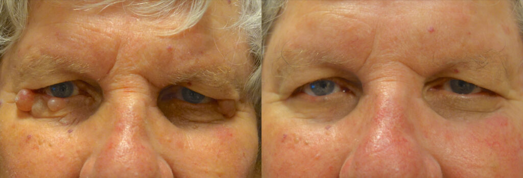 Eyelid Growth Patient-1