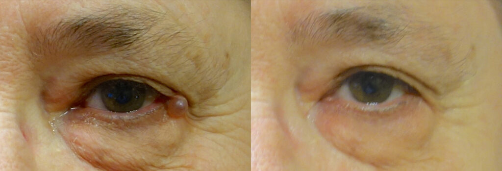 Eyelid Growth Patient-3