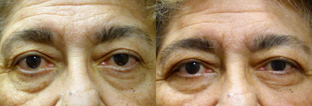 Eyelid Retraction Patient-1
