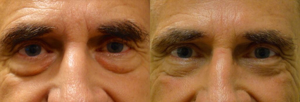 Lower Eyelid Patient-5