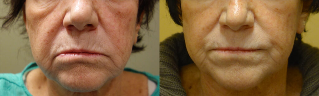 Injectable Filler Patient-1