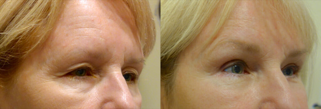 Browlift Patient-2