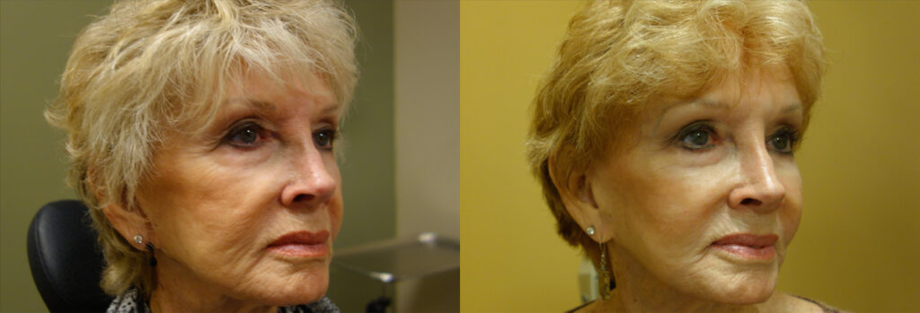 Injectable Filler Patient-2