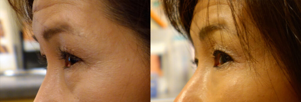 Injectable Filler Patient-3