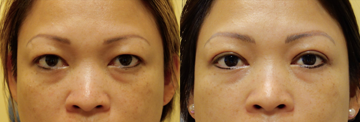 Asian Blepharoplasty Before and After Patient 2 Front Angle Dr. Joseph Infocus Inland Empire