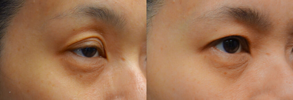Asian Eyelid Patient-3