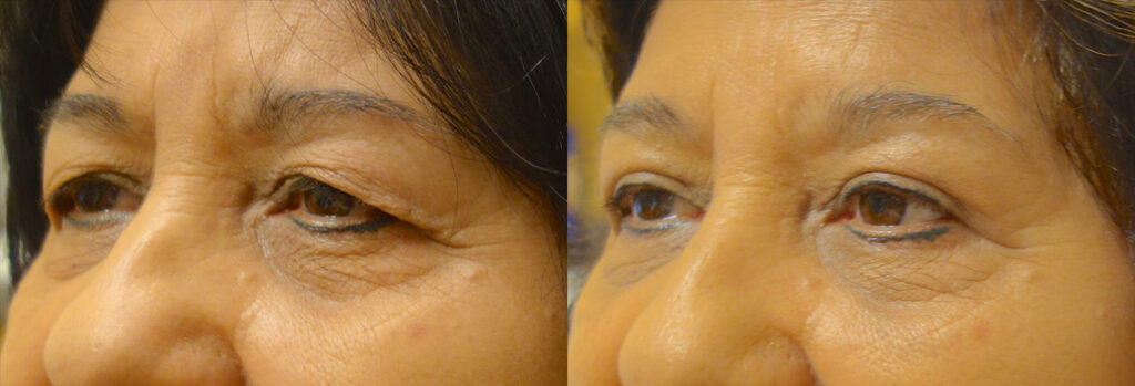 Upper Eyelid Patient-2