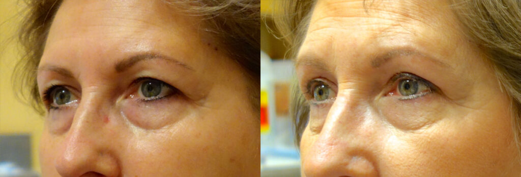 Upper Eyelid Patient-3