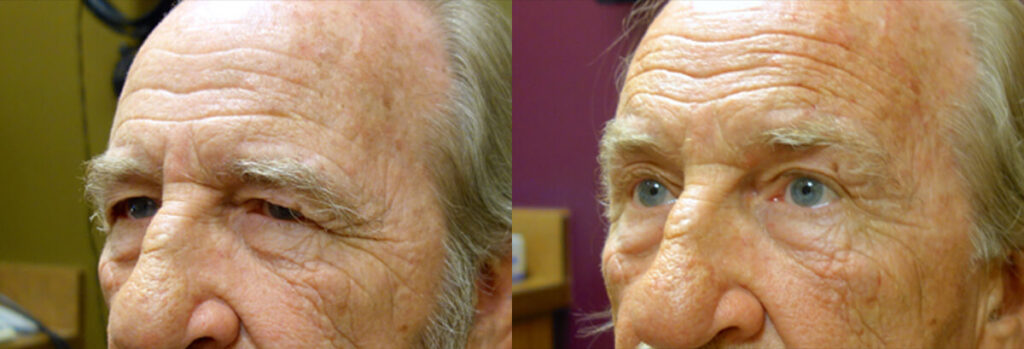 Browlift Patient-3