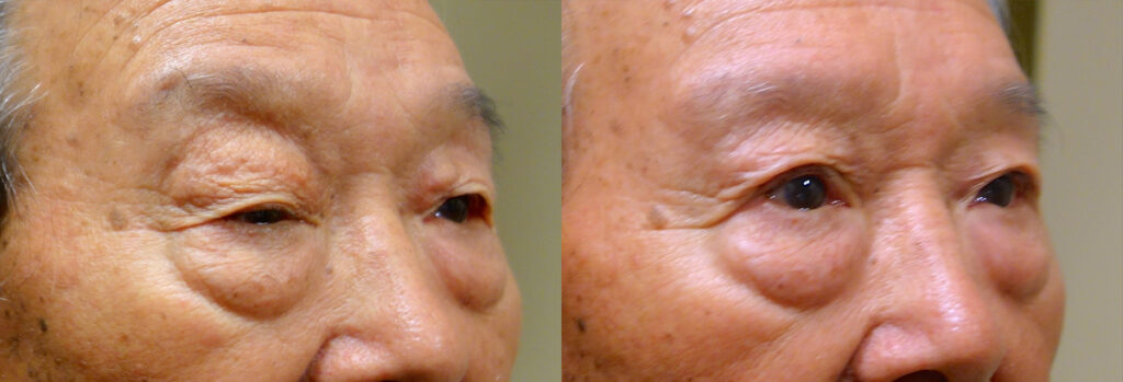 Eyelid surgery revision Patient