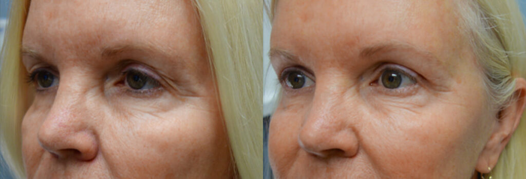 Browlift Patient-4