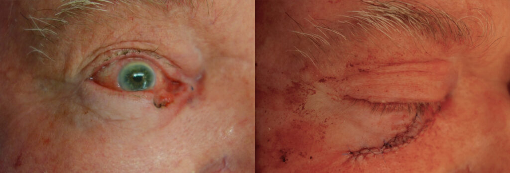 Eyelid Skin Cancer Patient-4