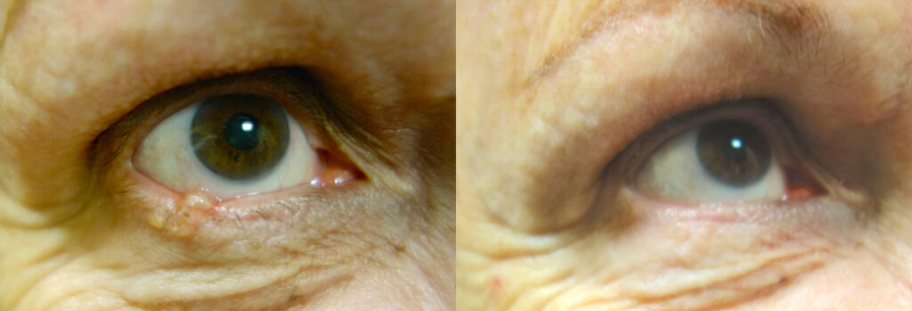 Eyelid Skin Cancer Patient-6