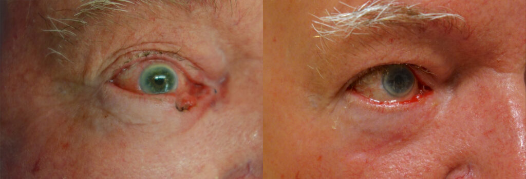 Eyelid Skin Cancer Patient-7
