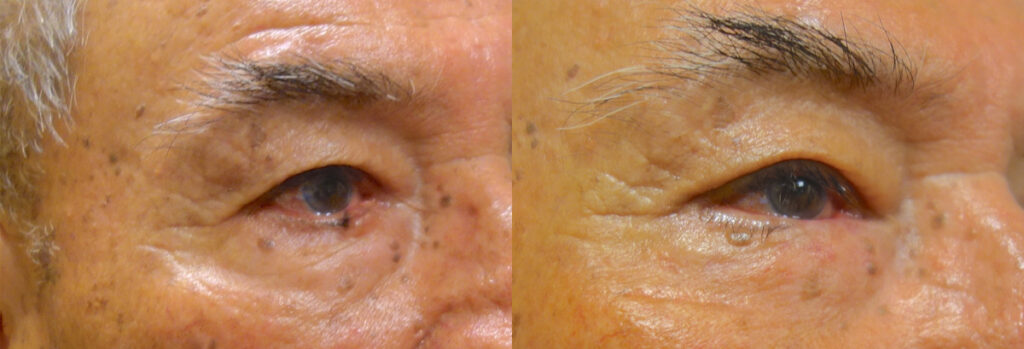 Eyelid Skin Cancer Patient-8