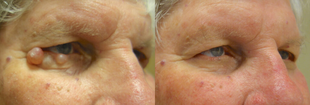 Eyelid Growth Patient-1