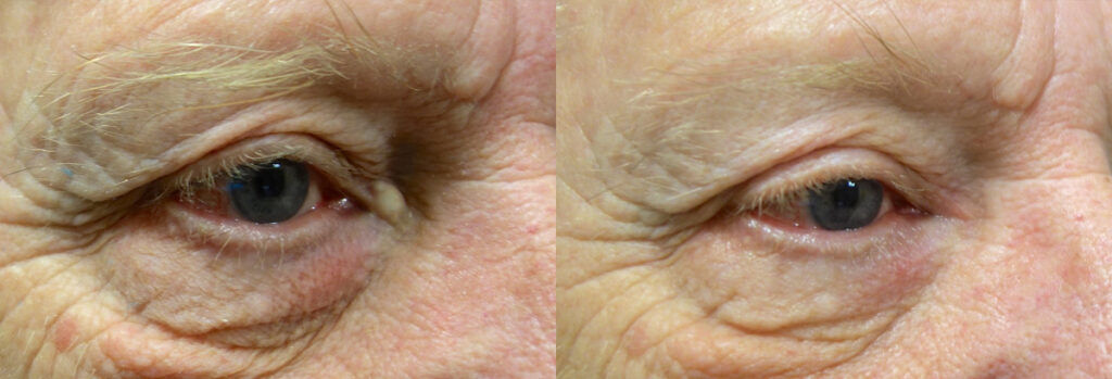 Eyelid Growth Patient-2