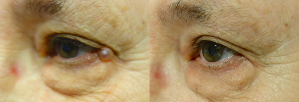 Eyelid Growth Patient-3