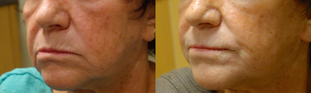 Injectable Filler Patient-1