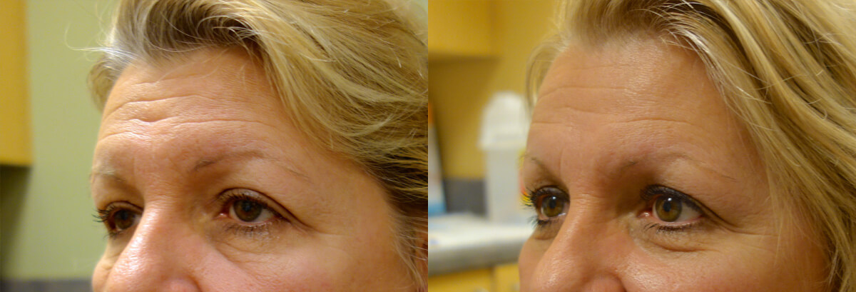 Brow Lift Before and After Patient 1 Dr. Joseph Infocus Inland Empire