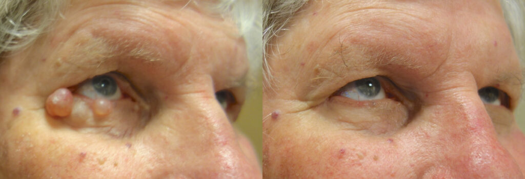 Eyelid Growth Patient-1