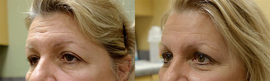 Before and After Patient Side Angle Upper Eyelid